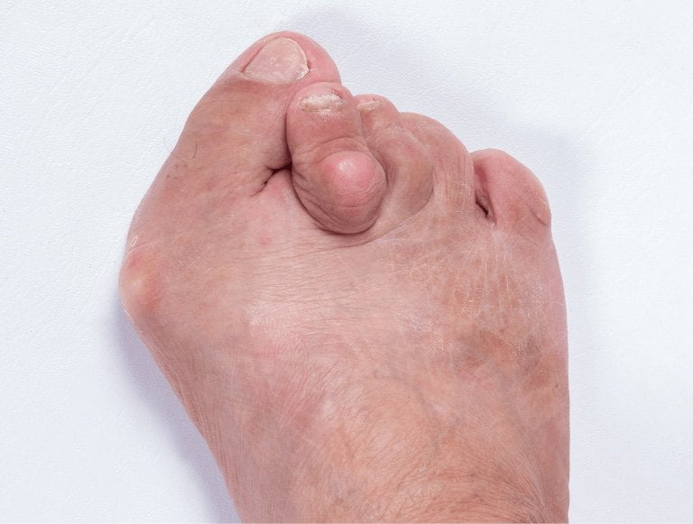 Post-Surgery Care for Bunions